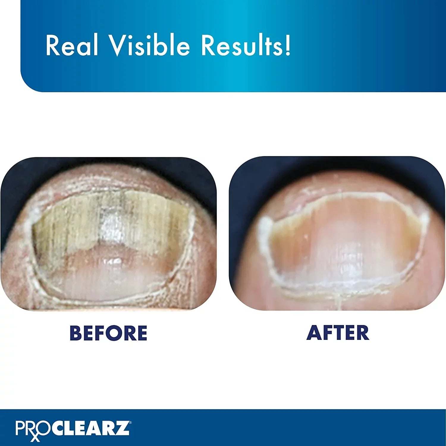 ProClearz Brite Now Nail Treatment, Restores The Appearance Of Damaged & Discolored Nails, Peel-Away Technology, Brightening & Smoothing Nail Repair, 0.5 Ounce